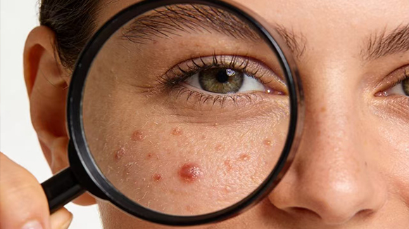 一水甜菜碱：调节表皮代谢，改善干燥粗糙，重塑紧致肌肤的秘密武器